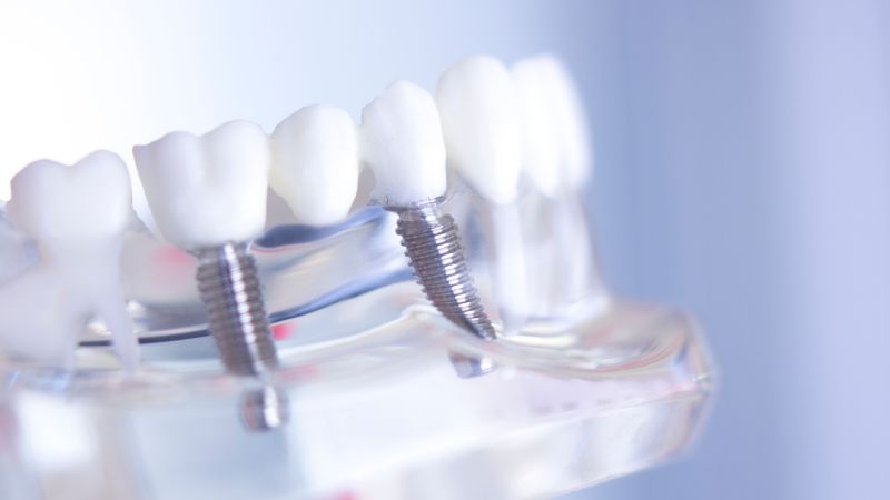 implantes dentales tenerife